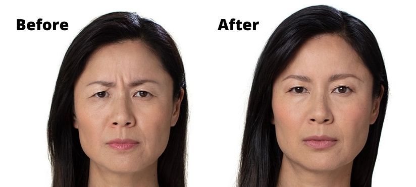Botox frown lines glabella Dubai Elaris