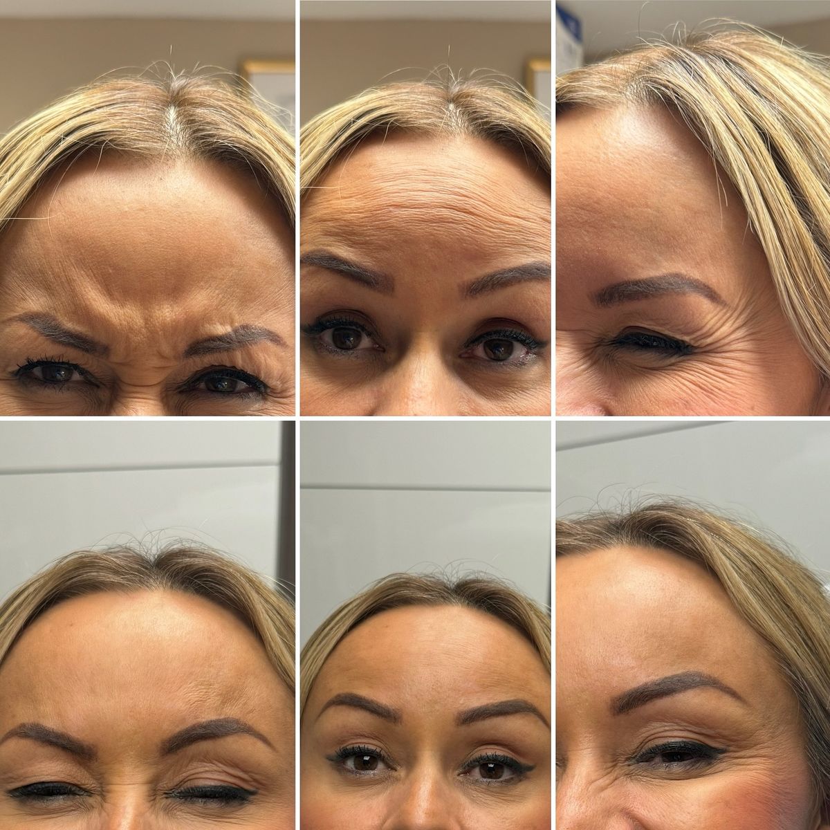 3 zone full face Botox Dubai Elaris