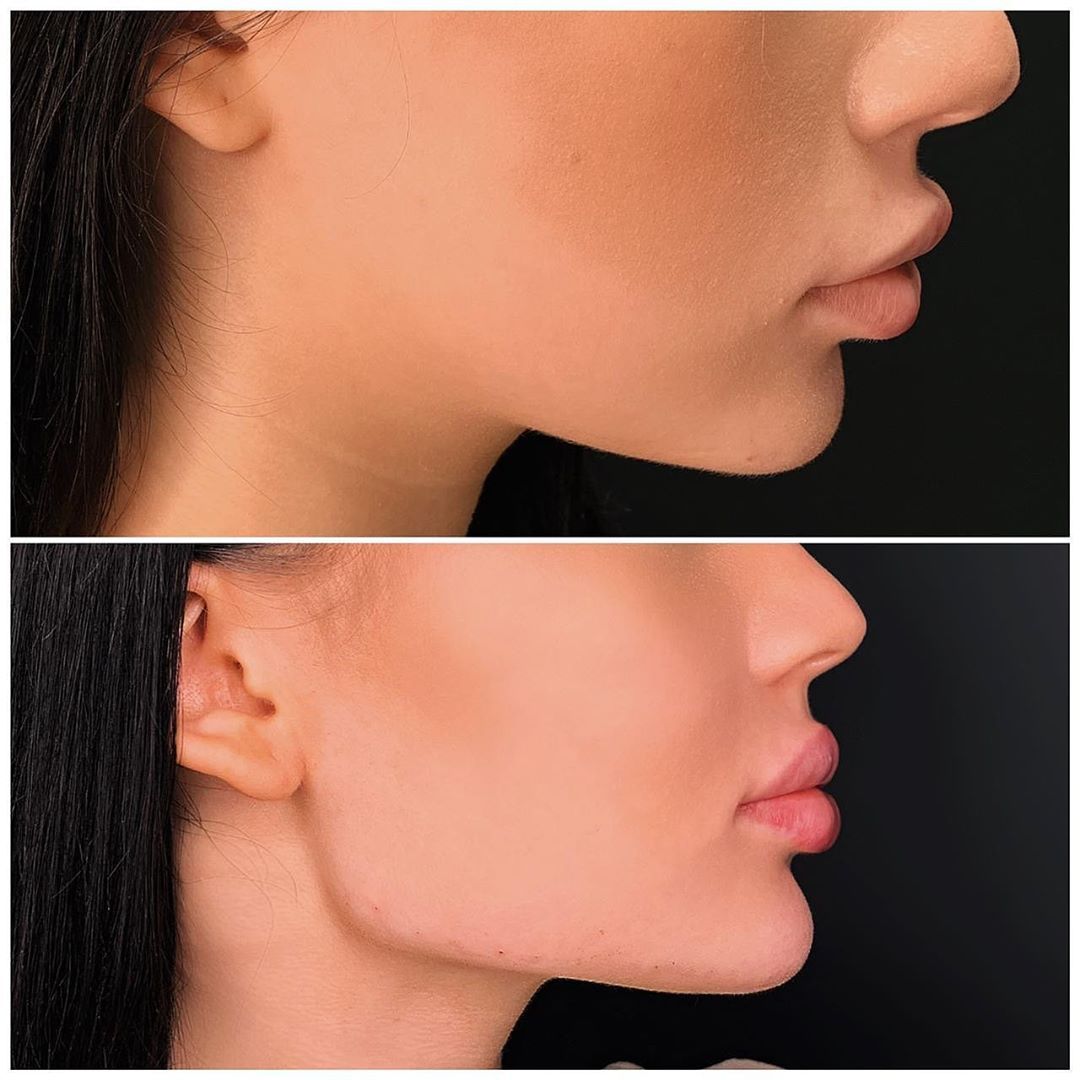 Jawline contouring Dubai Elaris