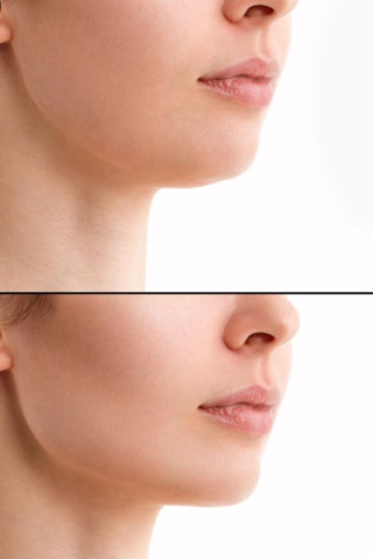 Chin jawline contouring Dubai Elaris