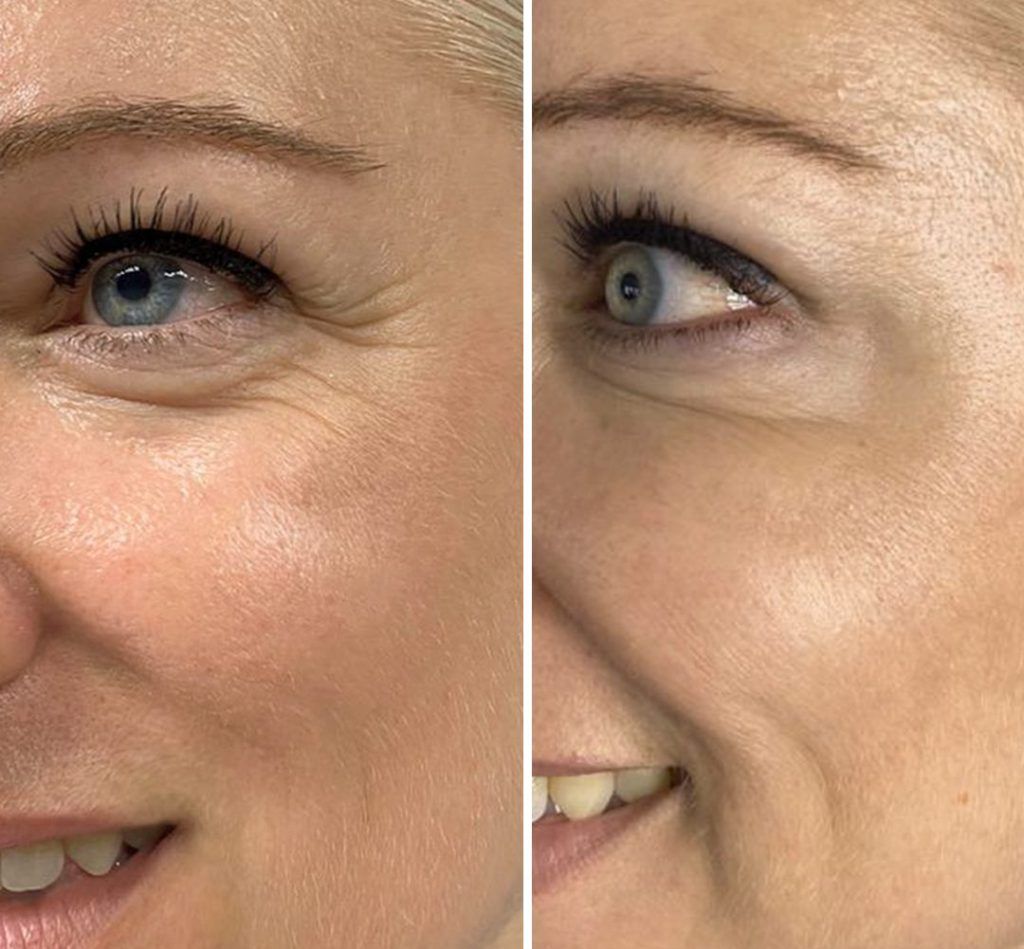 Botox crows feet Dubai Elaris