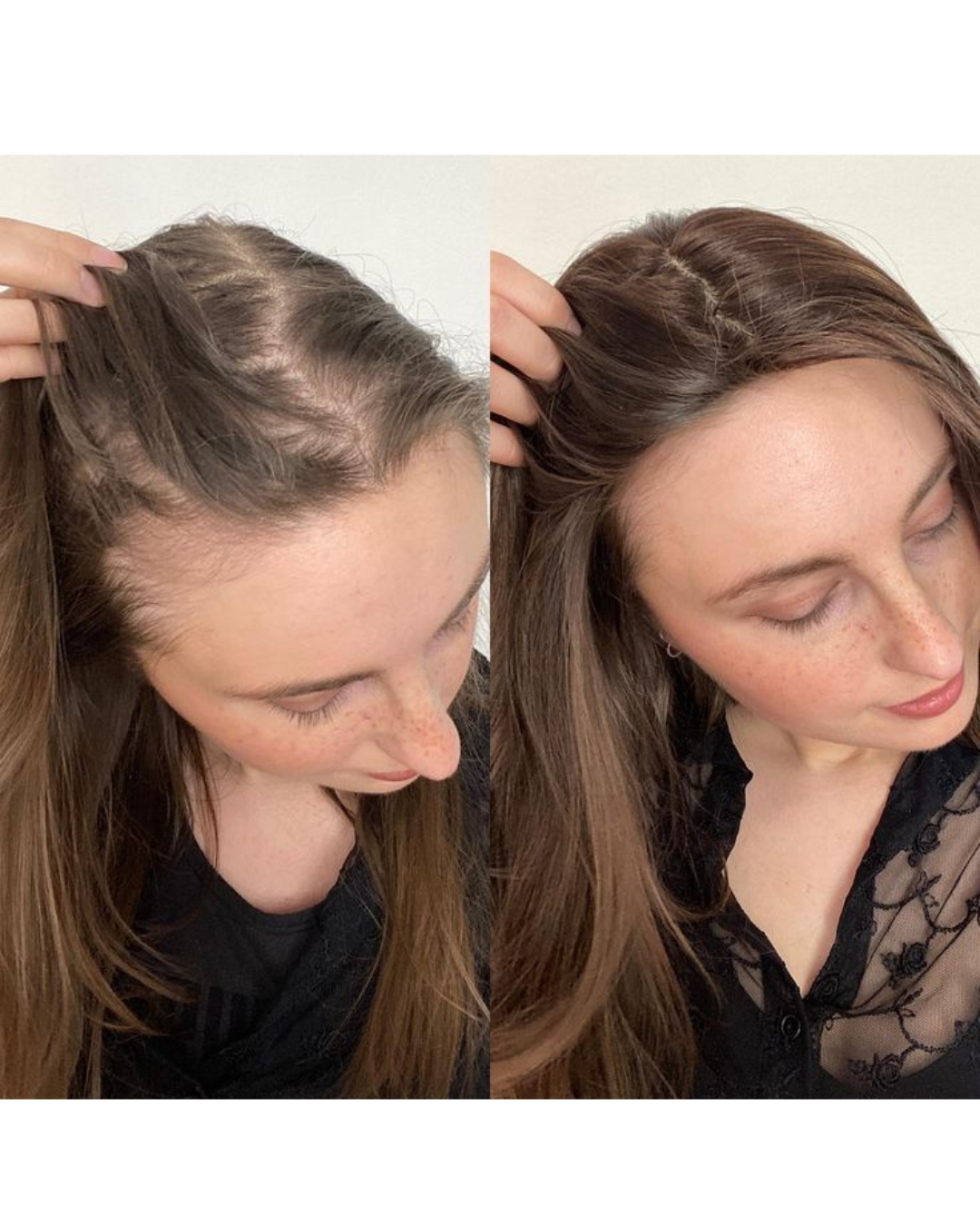 Female hair loss treatment outcome Dubai