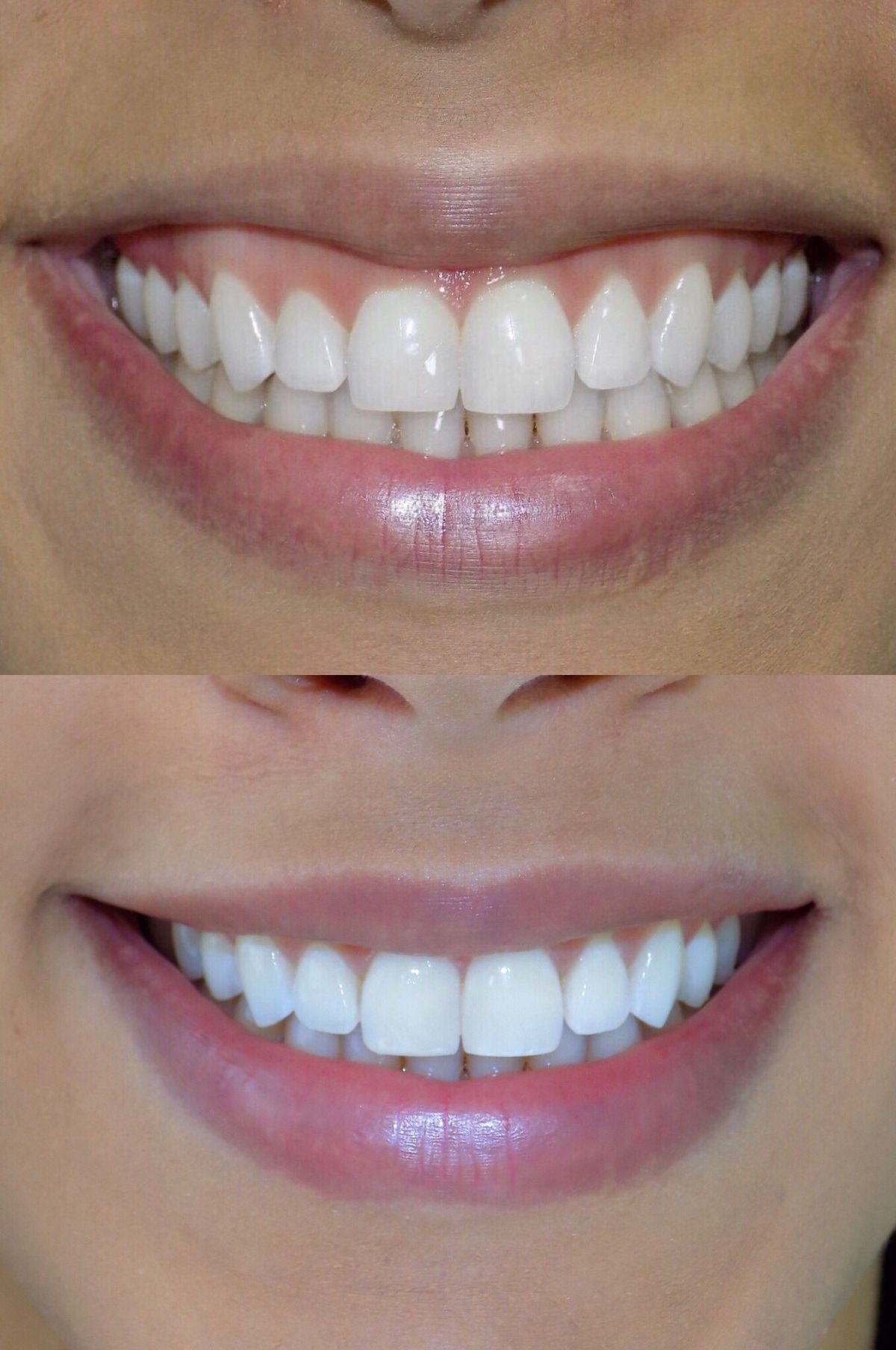 Gummy smile correction Botox Dubai Elaris