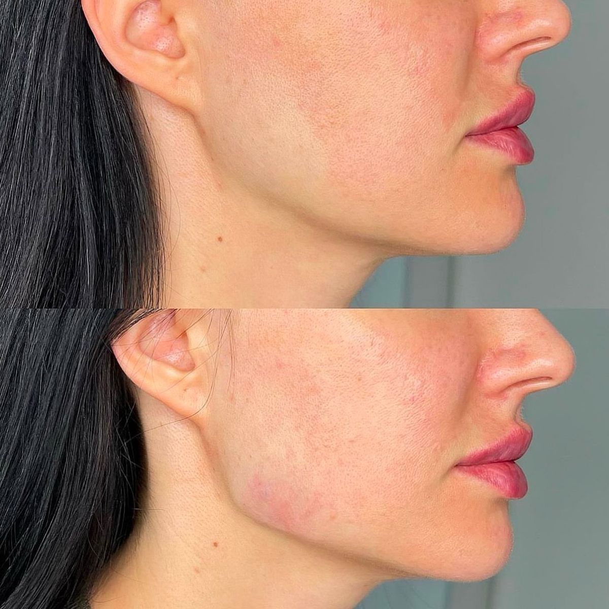 Masseter Botox jawline slimming Dubai Elaris