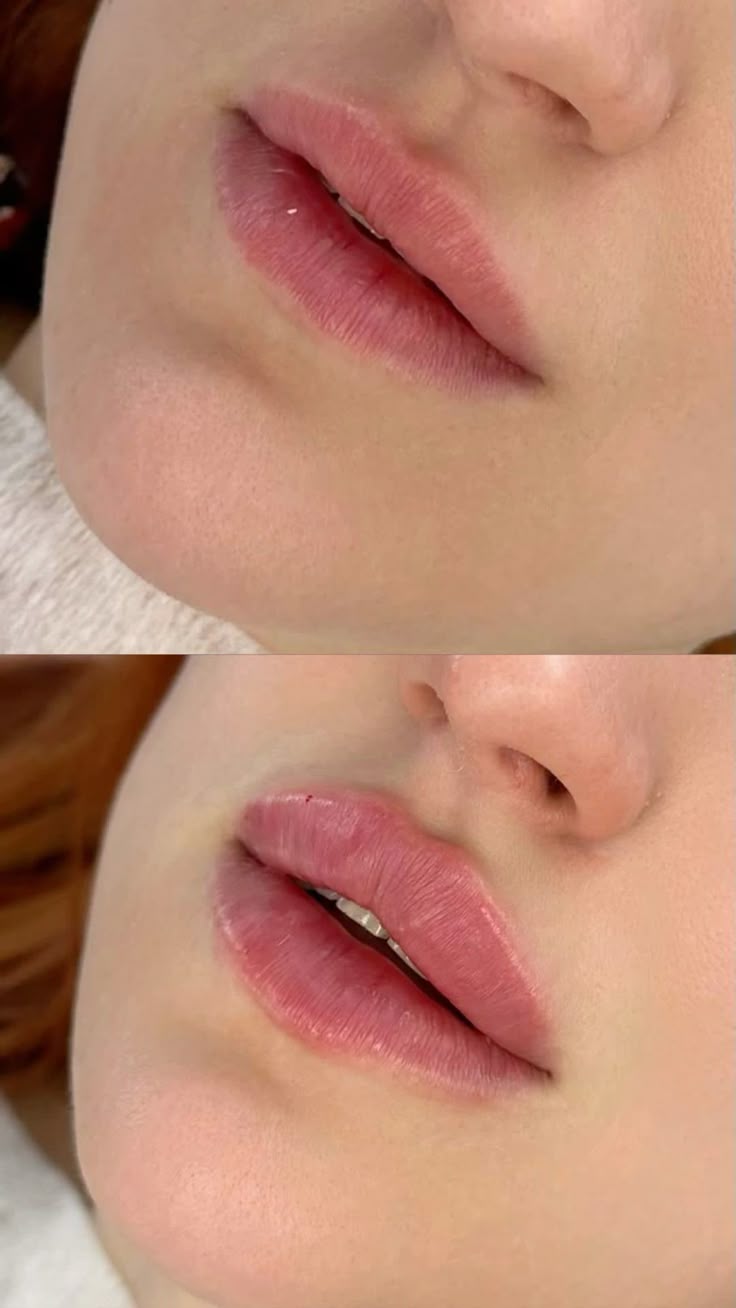 Lip filler result Dubai Elaris