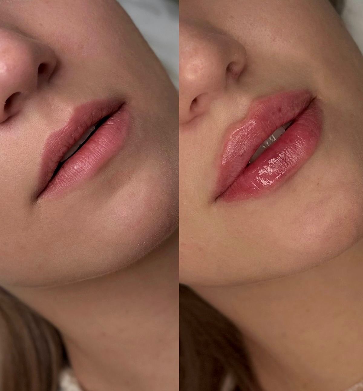 Lip treatment result Dubai Elaris