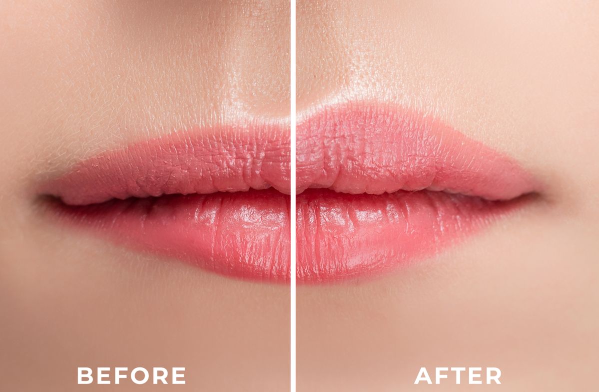 Lip flip Botox Dubai Elaris