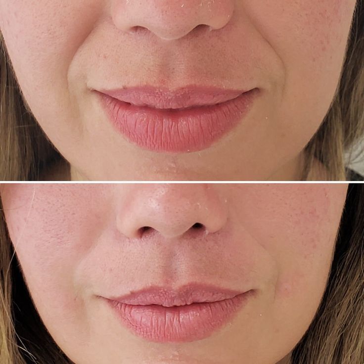Nasolabial treatment Dubai Elaris