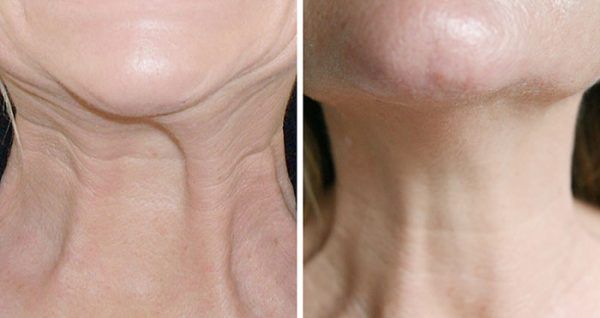 Nefertiti neck lift Botox Dubai Elaris